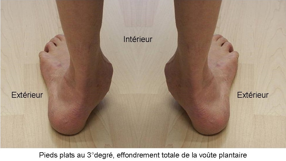 Semelles Orthopédiques Enfants Sonew - Correction Pieds Plats, Valgus, Pronation, Matériau EVA Respirant